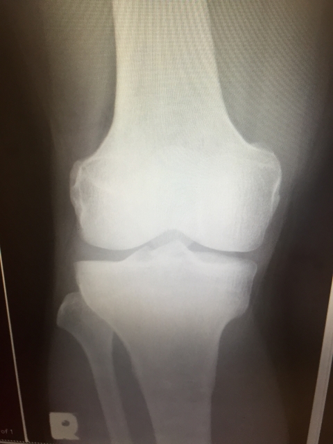 変形性膝関節症のレントゲン画像
